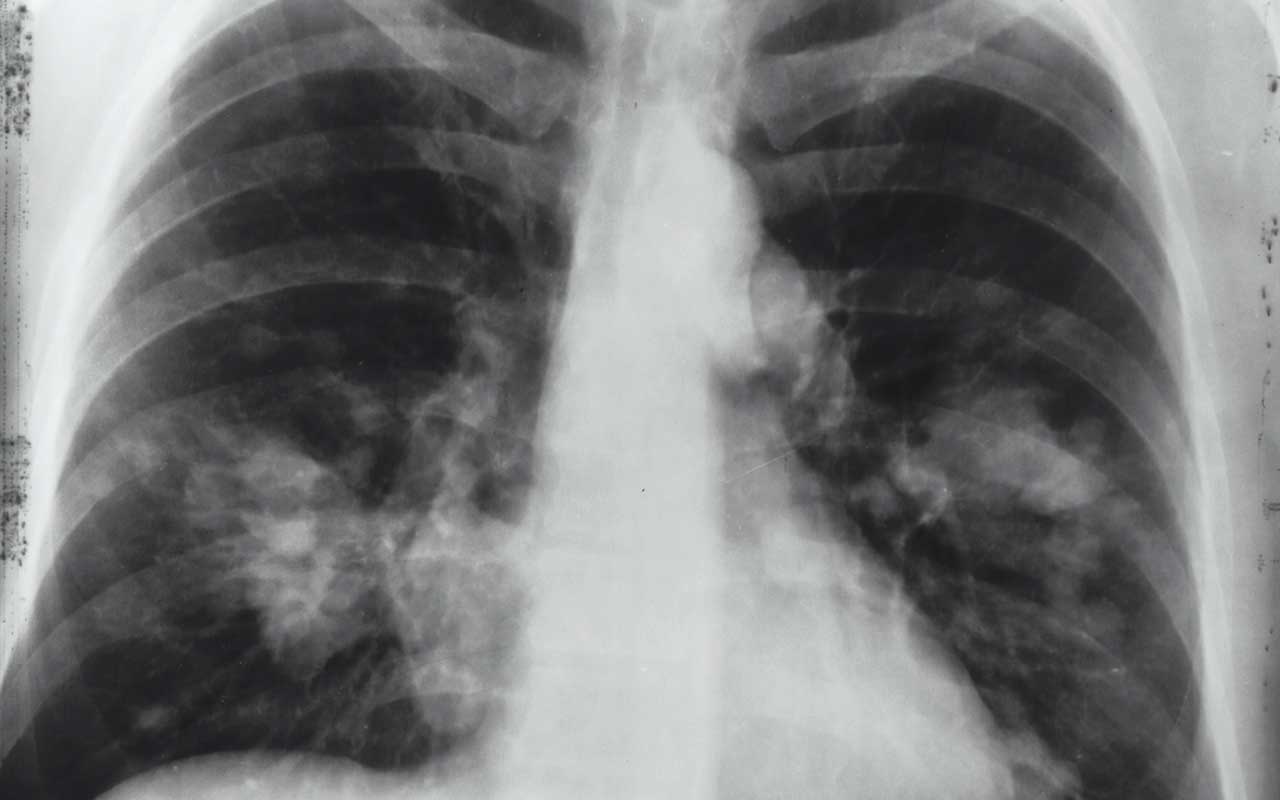 cancer lung